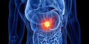 AI Holds Promise for Early Detection of Pancreatic Cancer, Revolutionizing Prognosis