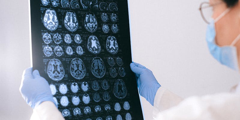 AI Predicts Alzheimer’s Seven Years Early: UCSF Study Finds Key Indicators